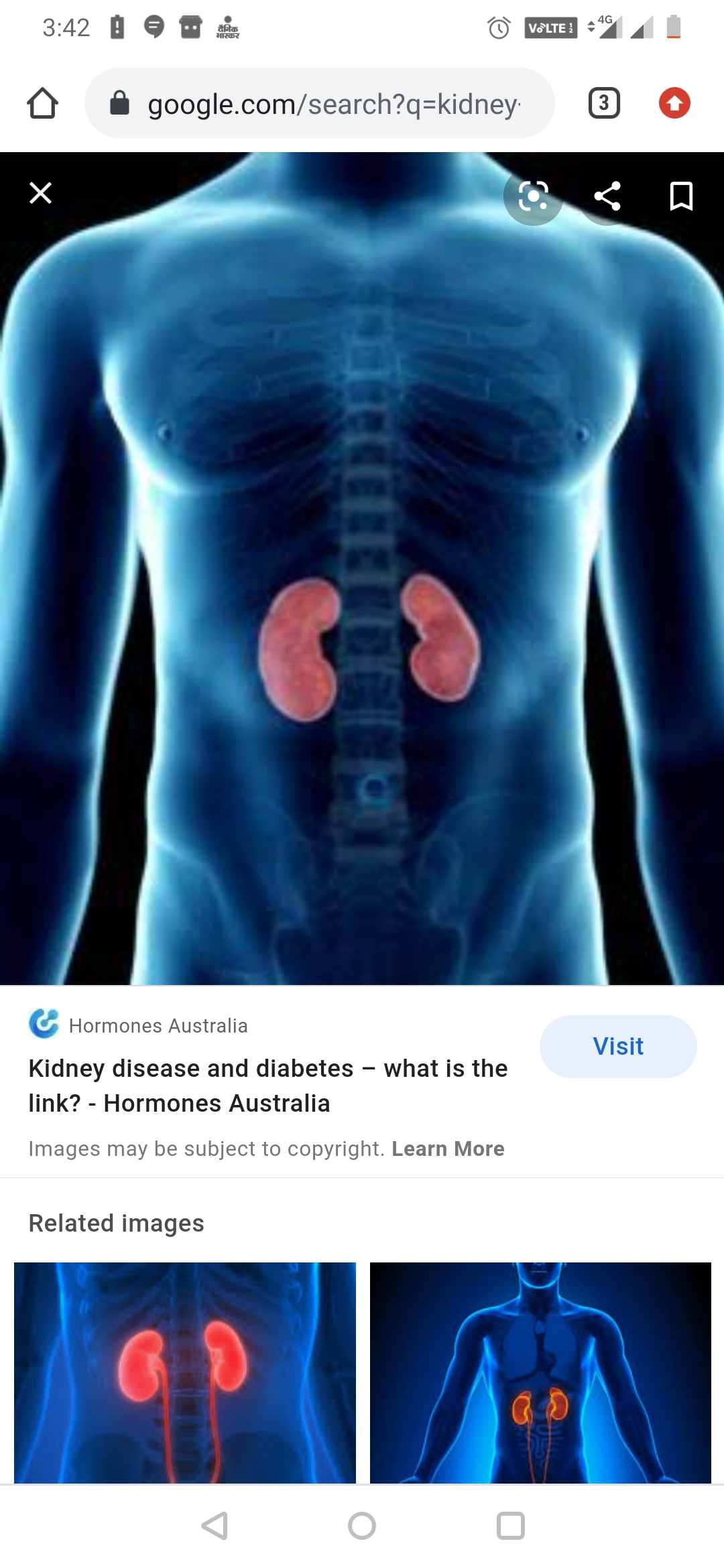 Diabetic kidney and dialysis